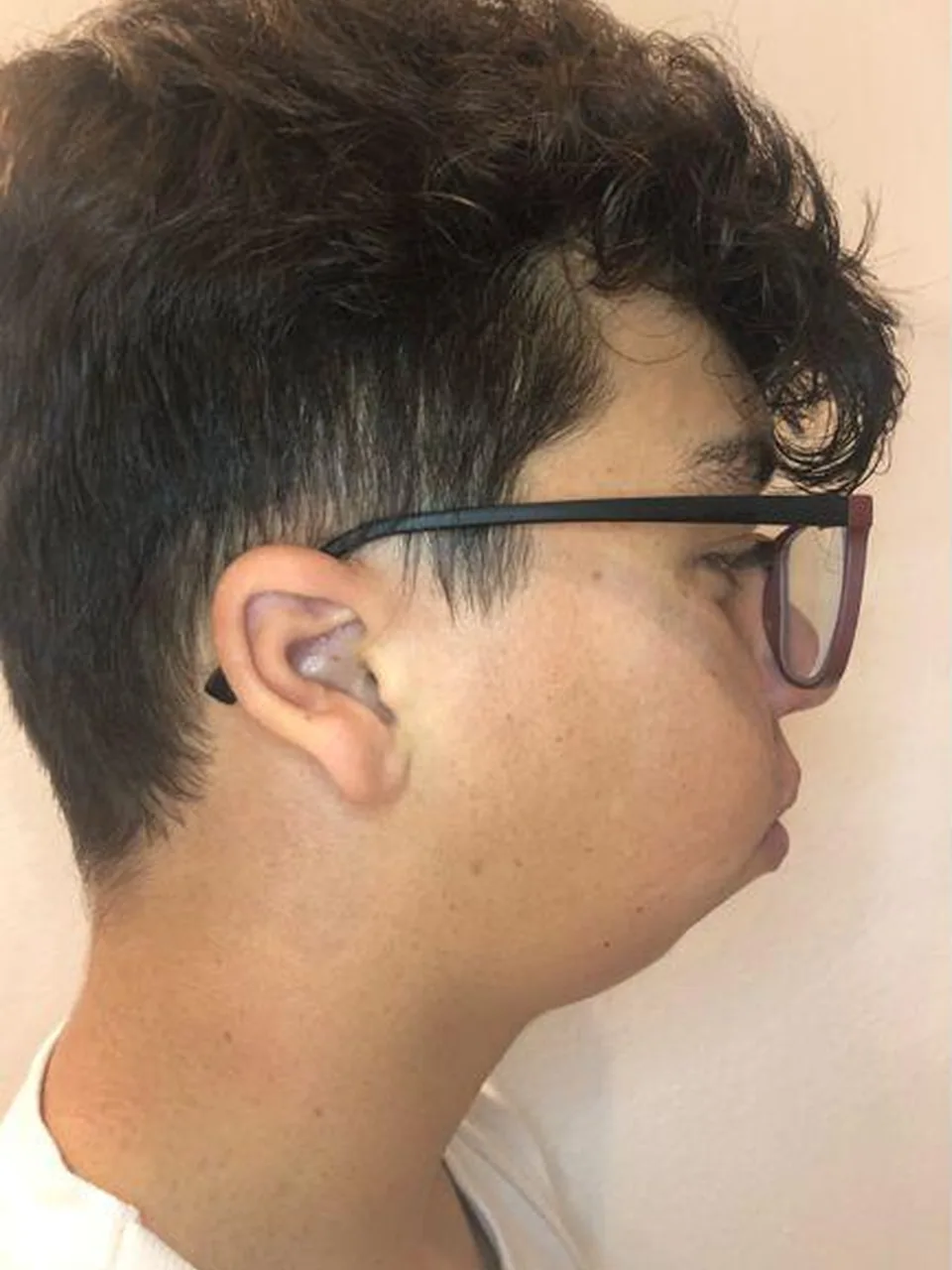 Antes — retrognatismo mandibular severo, perfil