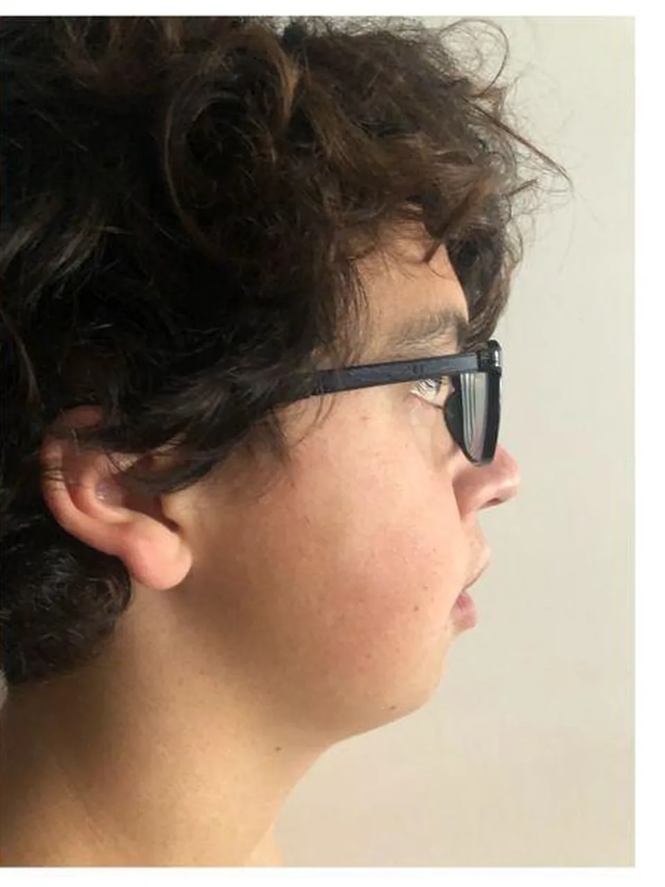 Después — avance mandibular, perfil