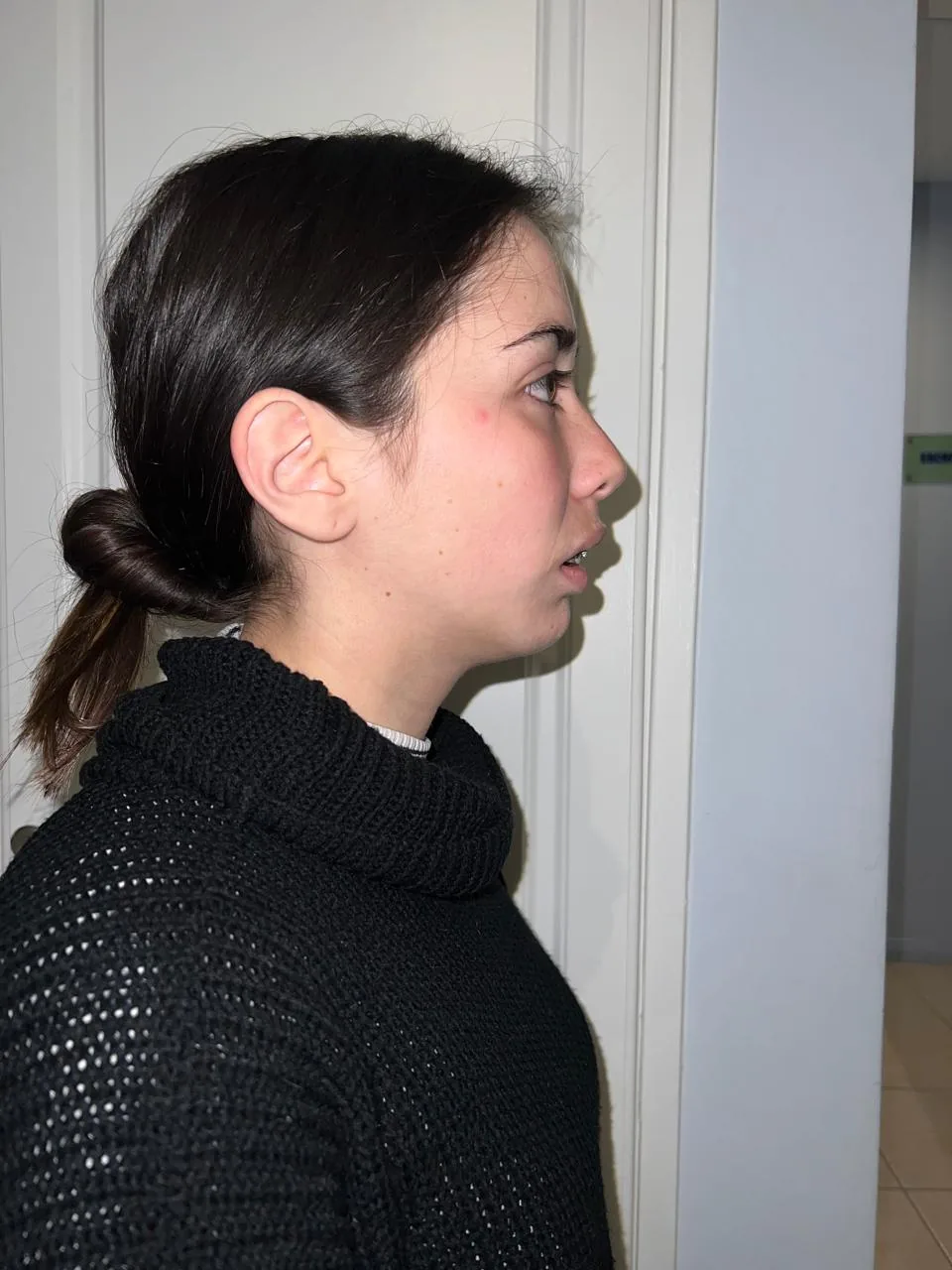 Antes — exceso vertical de maxilar superior y retrognatismo mandibular, perfil