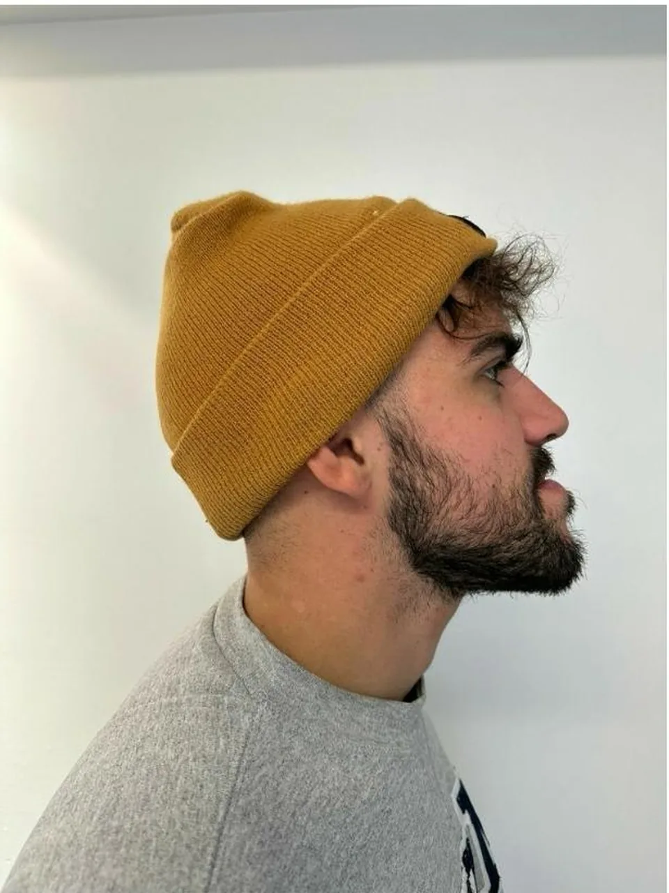 Antes — prognatismo mandibular severo, perfil