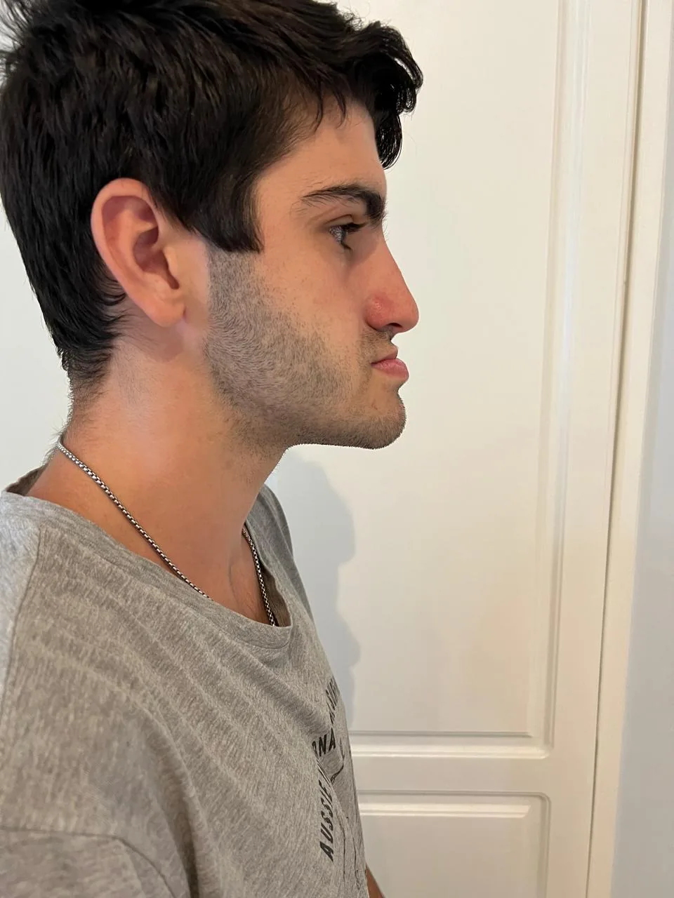 Antes — perfil con proyección mandibular